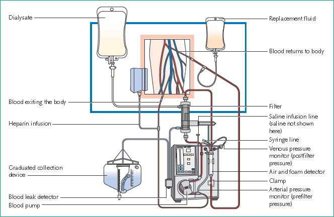 CRRT (Continuous Renal Replacement Therapy)